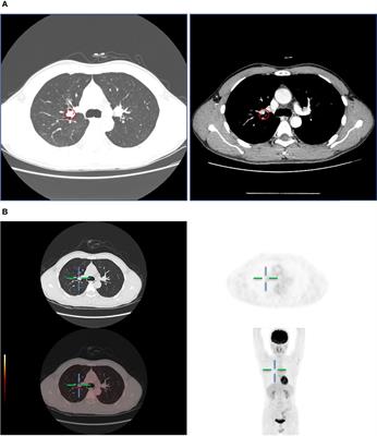 Gene Expression and Mutational Landscape in a PMEC Patient With Low to Intermediate-High Grade Transition